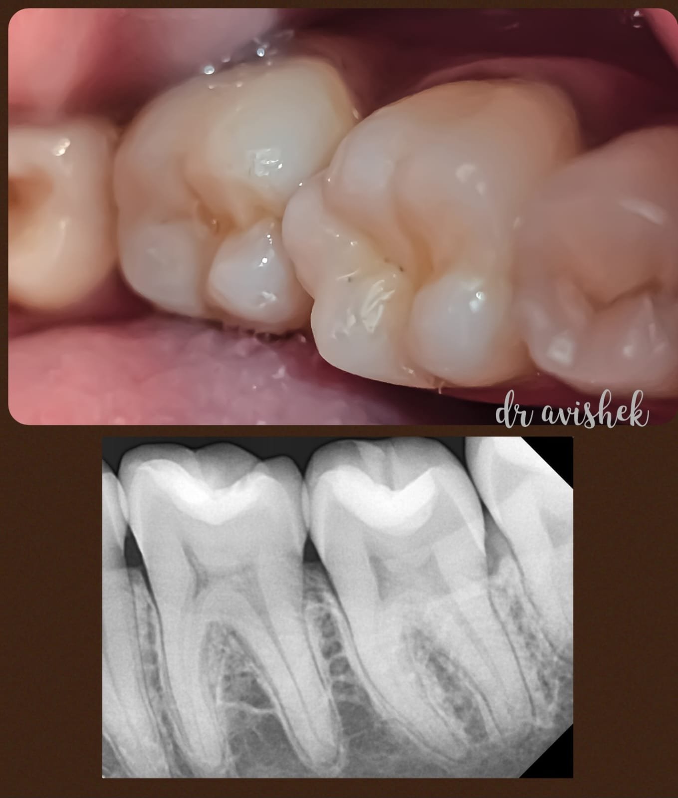Dental Restoration treatment