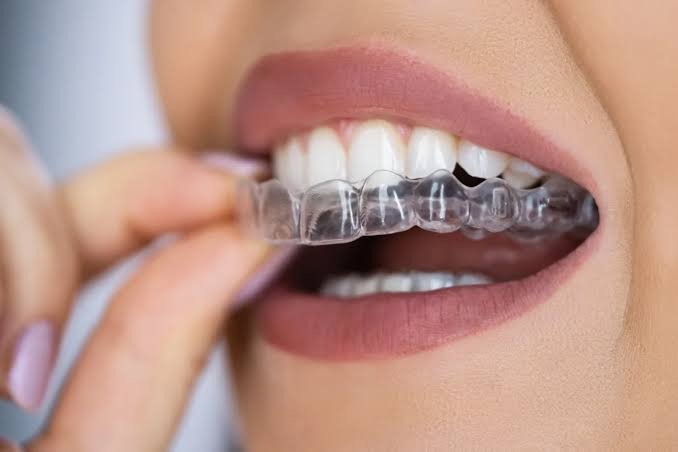 Clear Aligner treatment